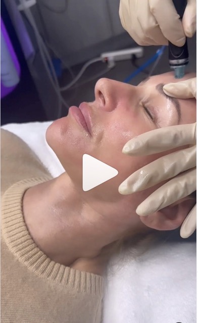 Hydrafacial in Glendale, Encino, and Irvine, CA | New Look Skin Center Medical Spa in Glendale, Encino and Irvine, CA