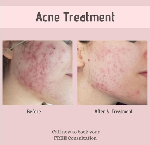Acne Treatment Before and After in Glendale, Encino, and Irvine, CA | New Look Skin Center Medical Spa in Glendale, Encino and Irvine, CA