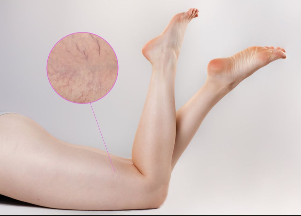 Sclerotherapy | New Look Skin Center Medical Spa in Glendale, Encino and Irvine, CA