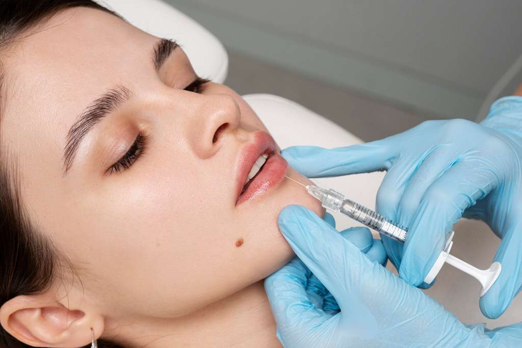 Lip Fillers | New Look Skin Center Medical Spa in Glendale, Encino and Irvine, CA