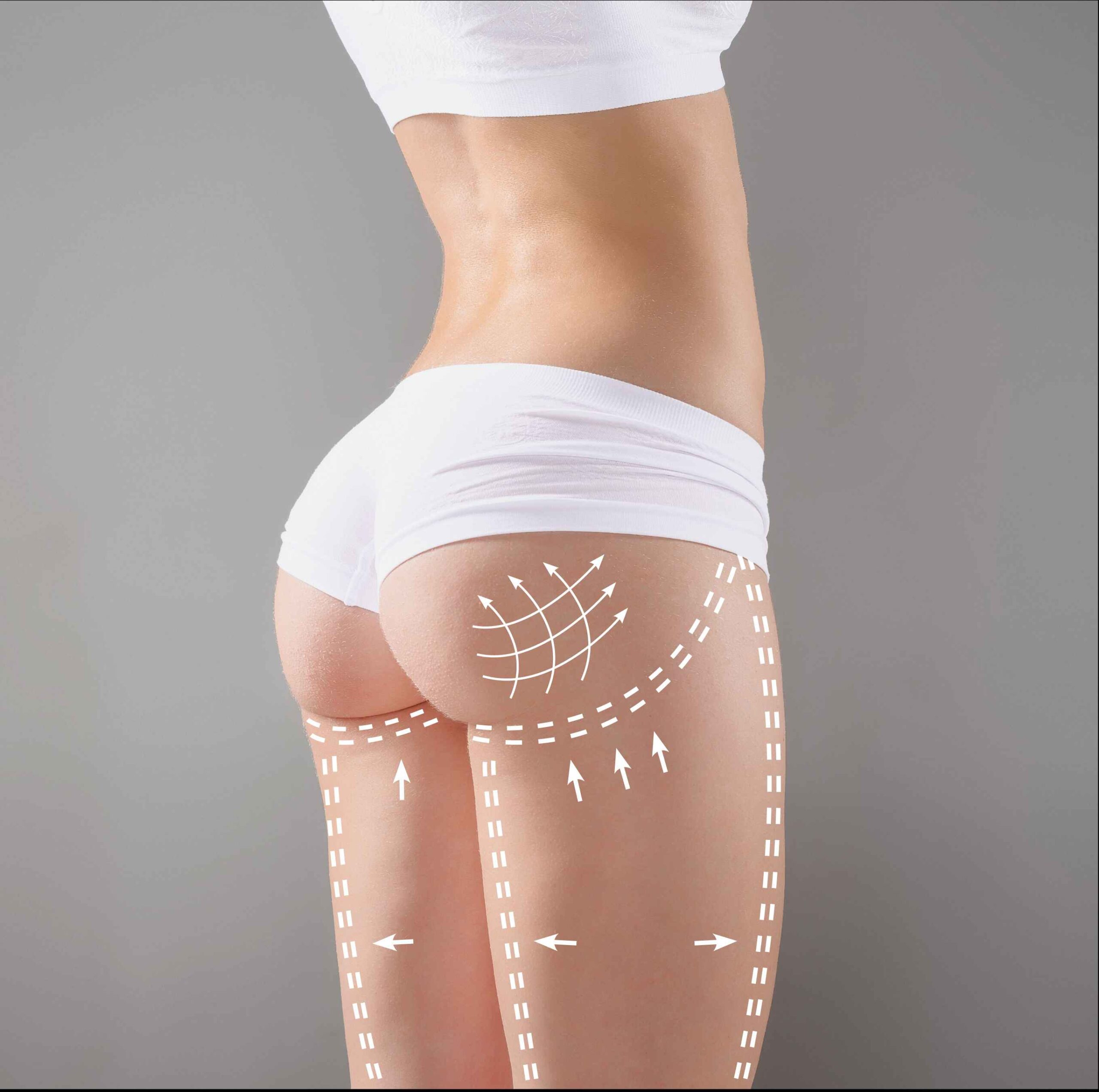 Non Surgical bbl | New Look Skin Center Medical Spa in Glendale, Encino and Irvine, CA
