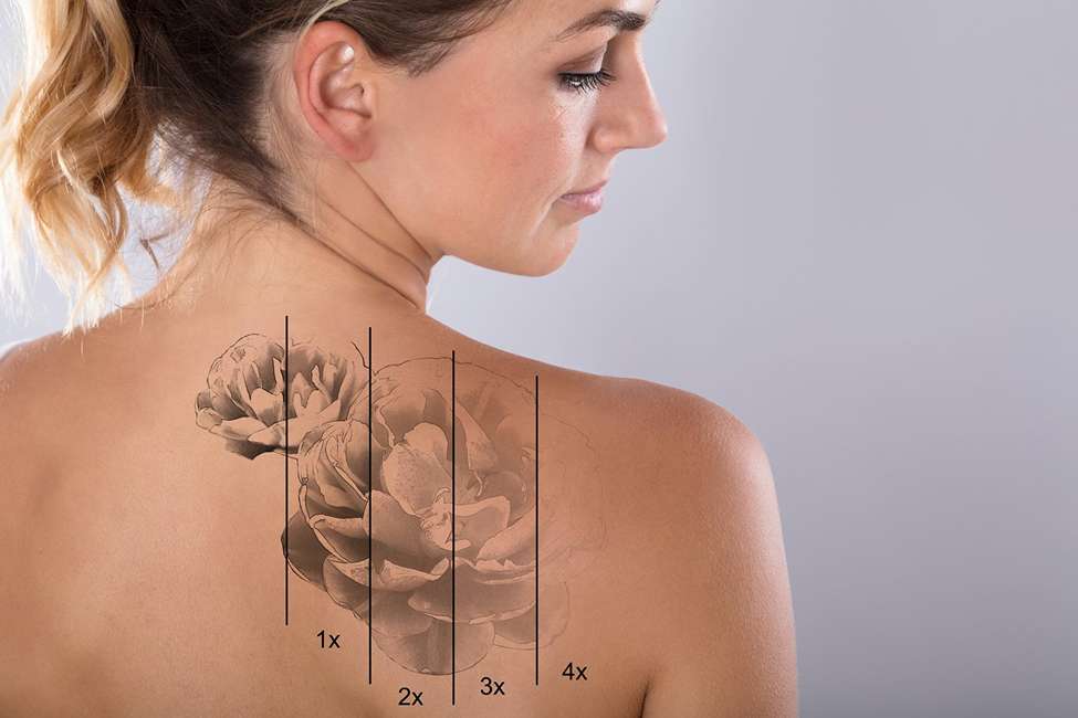 Laser Tattoo Removal | New Look Skin Center Medical Spa in Glendale, Encino and Irvine, CA