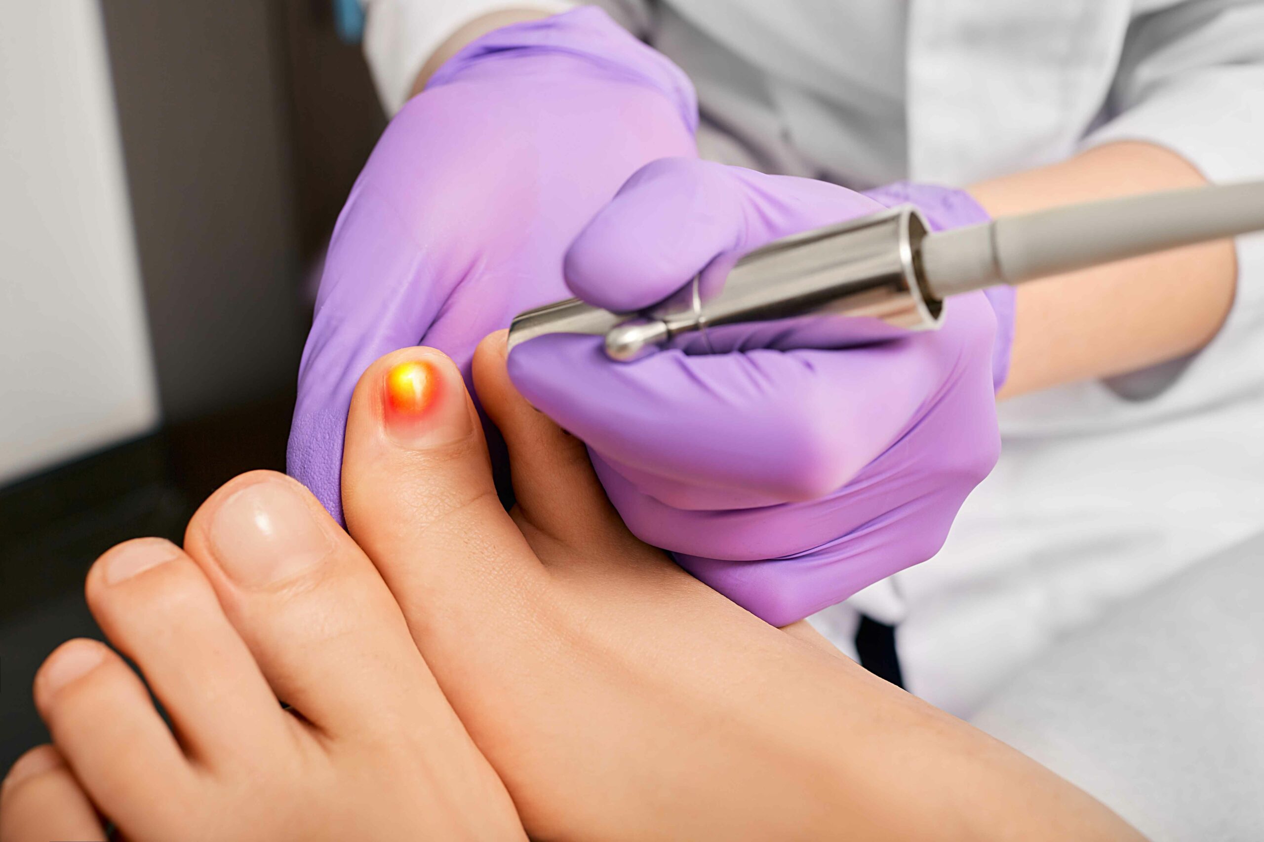 Laser Nail Fungus in Glendale, Encino, and Irvine, CA | New Look Skin Center Medical Spa in Glendale, Encino and Irvine, CA