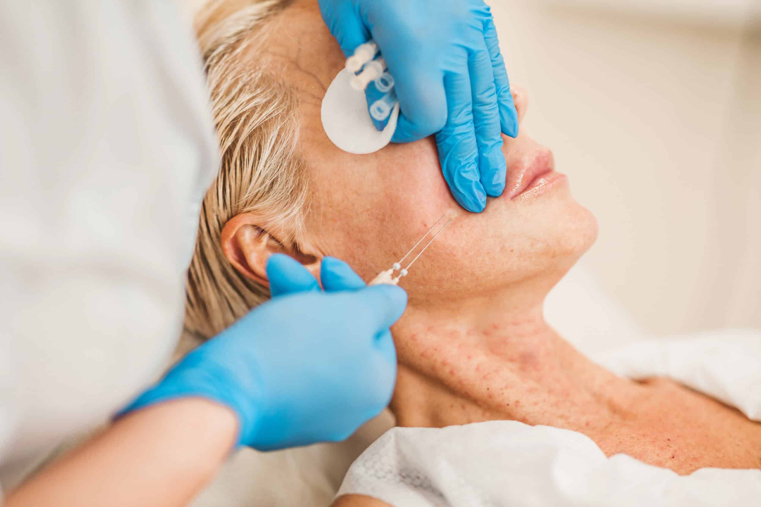Thread Lift in Glendale, Encino, and Irvine, CA | New Look Skin Center Medical Spa in Glendale, Encino and Irvine, CA