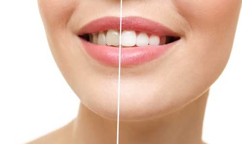 Teeth Whitening | New Look Skin Center Medical Spa in Glendale, Encino and Irvine, CA
