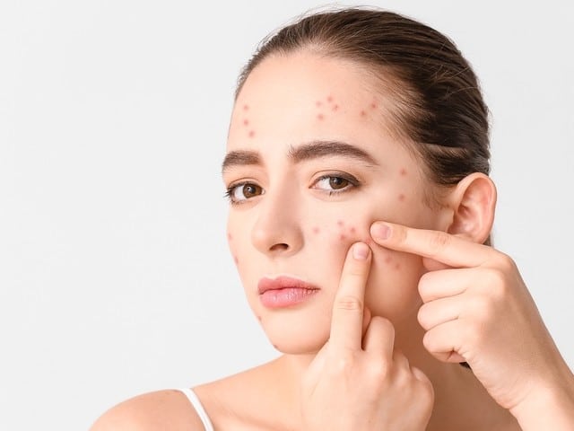 Acne Scar Treatments | New Look Skin Center Medical Spa in Glendale, Encino and Irvine, CA