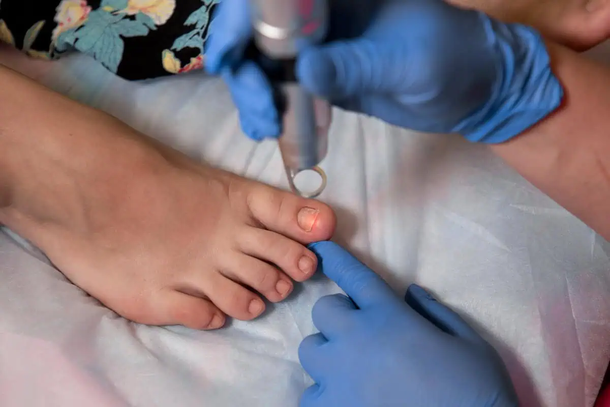 Toenail fungus treatment with foot laser at laser nail therapy in New Look Skin Center