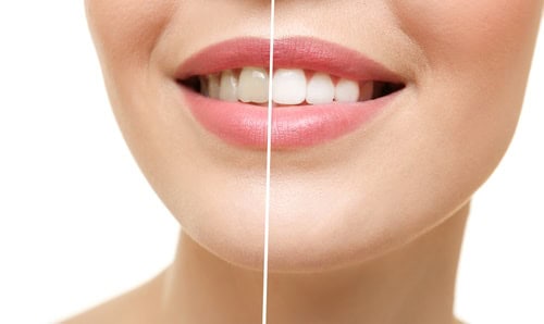 Teeth Whitening | New Look Skin Center Medical Spa in Glendale, Encino and Irvine, CA