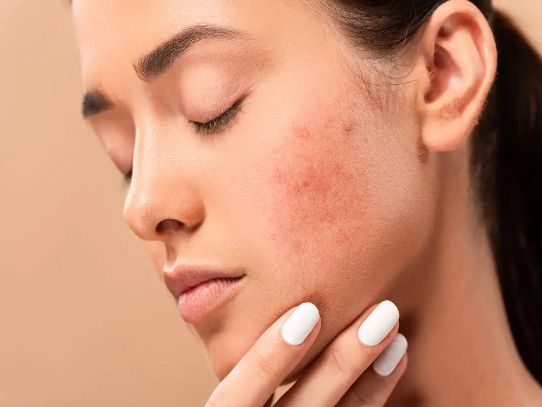 Acne Treatment at New Look Skin Center