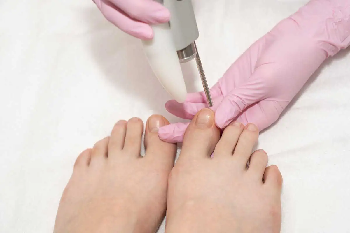 Laser Fungal Nail Treatment by New Look Skin Center in Glendale, Encino and Irvine CA