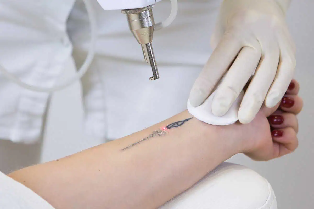 Laser Tattoo Removal in Glendale, Encino, Irvine, CA at New Look Skin Center